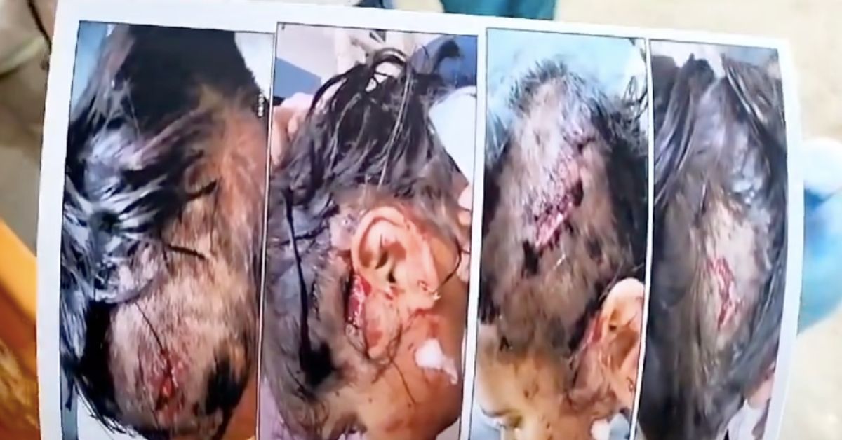 मिर्जापुर त्रासदी: स्कूली छात्रा पर जर्मन शेफर्ड का भयानक हमला, पालतू कुत्तों की लापरवाही पर प्रबंधन के खिलाफ कार्रवाई
